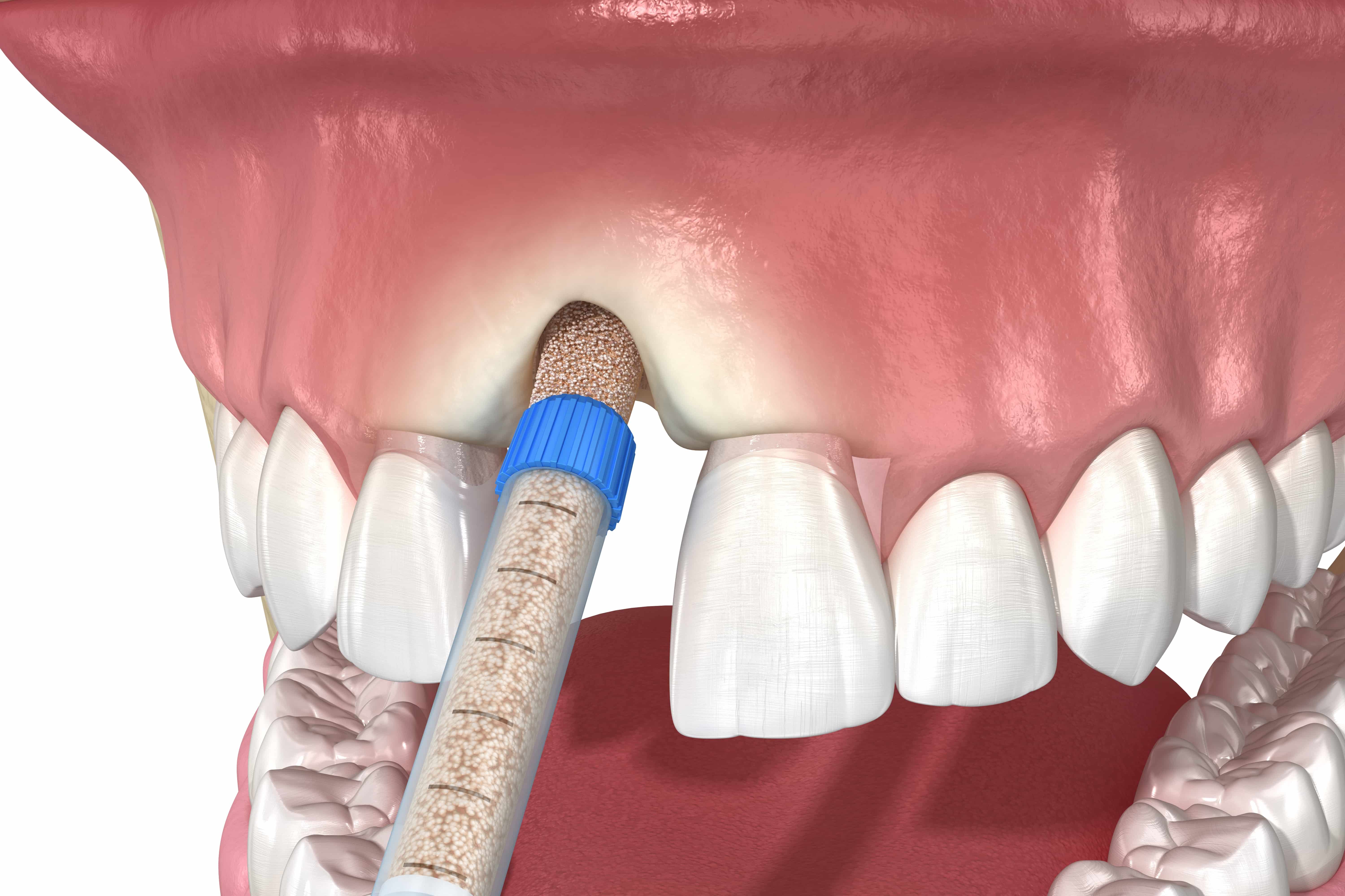 Bone Grafting Hoboken NJ