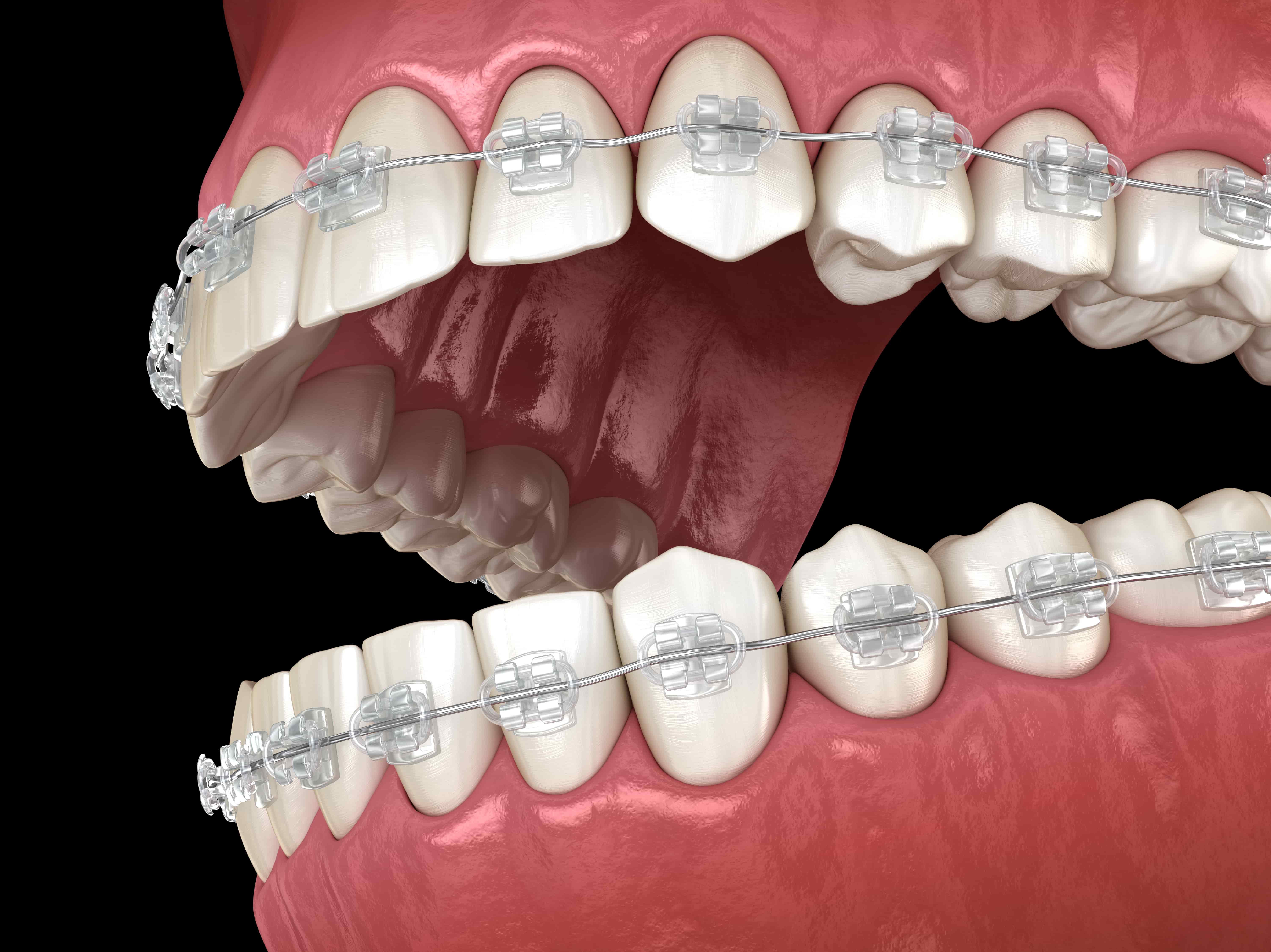 Orthodontic Braces Secaucus NJ