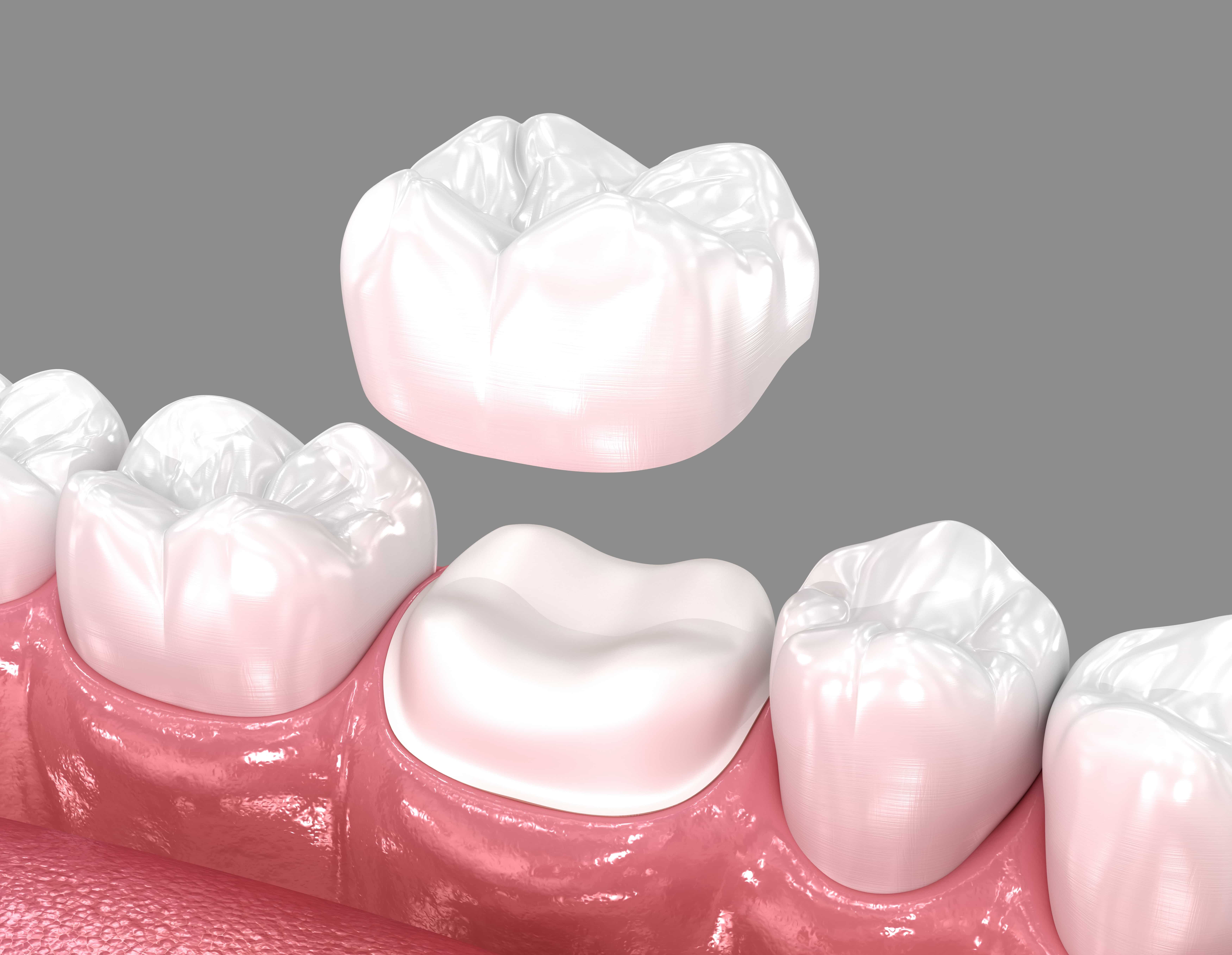 Porcelain Crowns Hoboken NJ