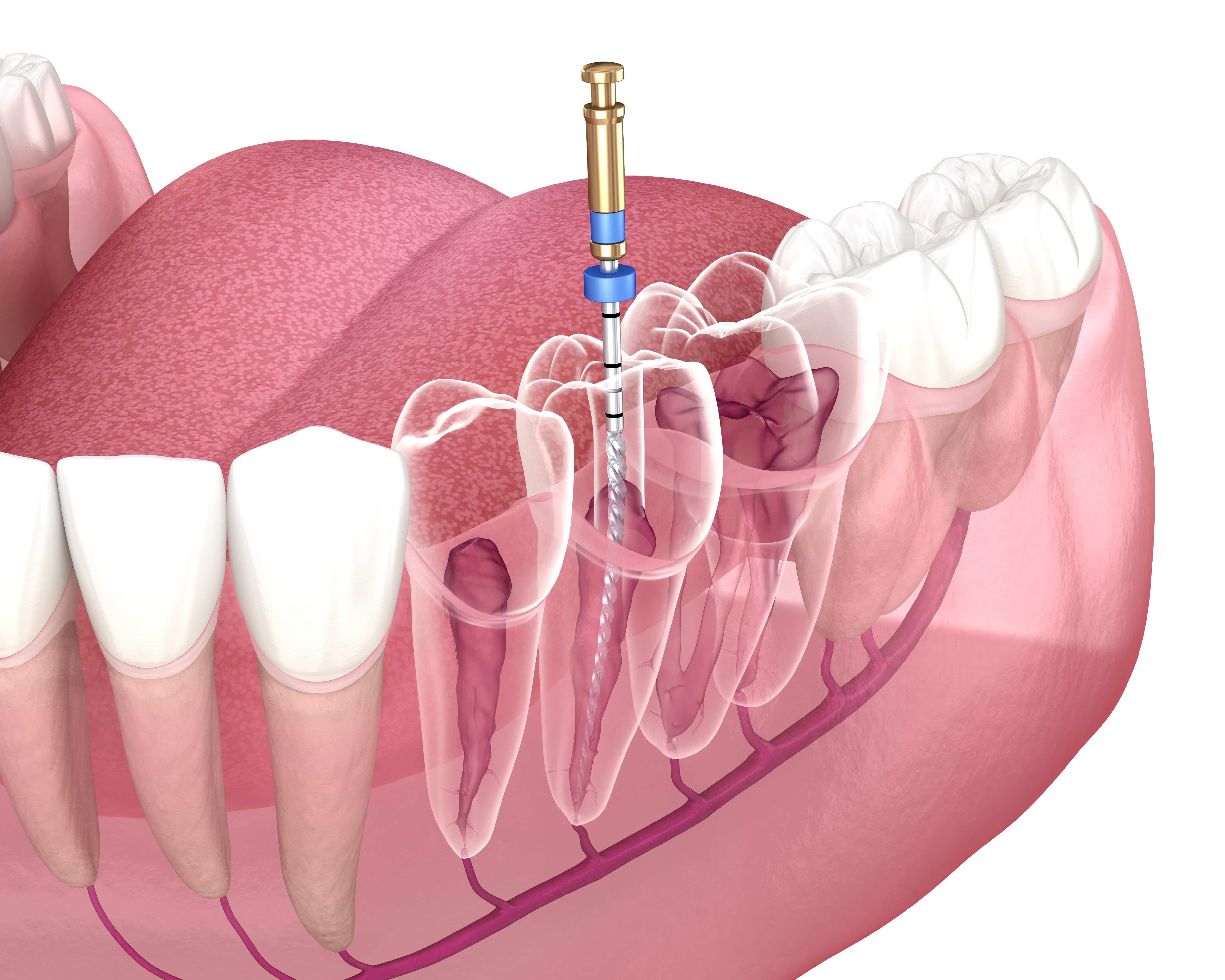 Root Canals Hoboken NJ
