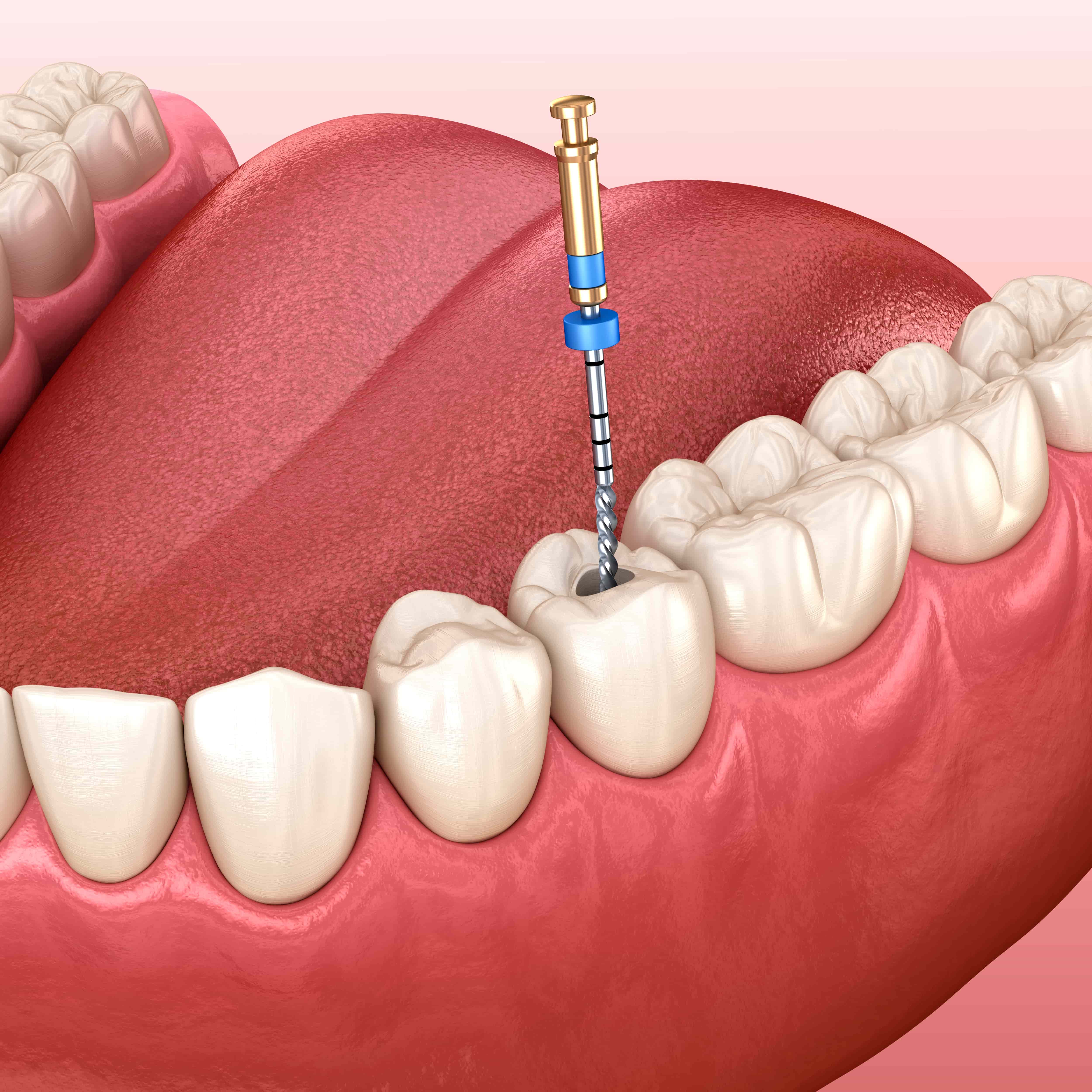 Root Canal Treatment Secaucus NJ