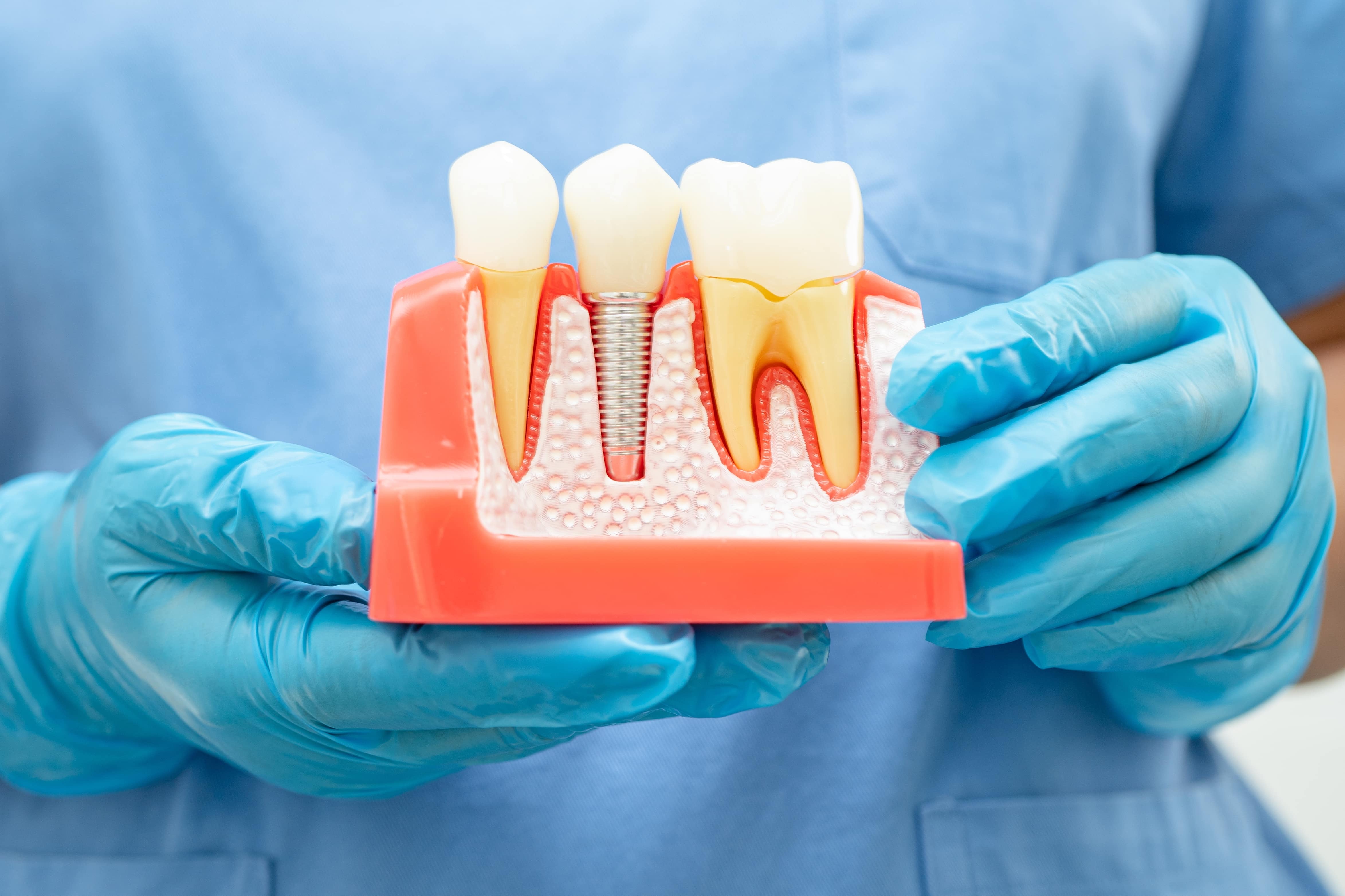 Dental Implants Hoboken NJ