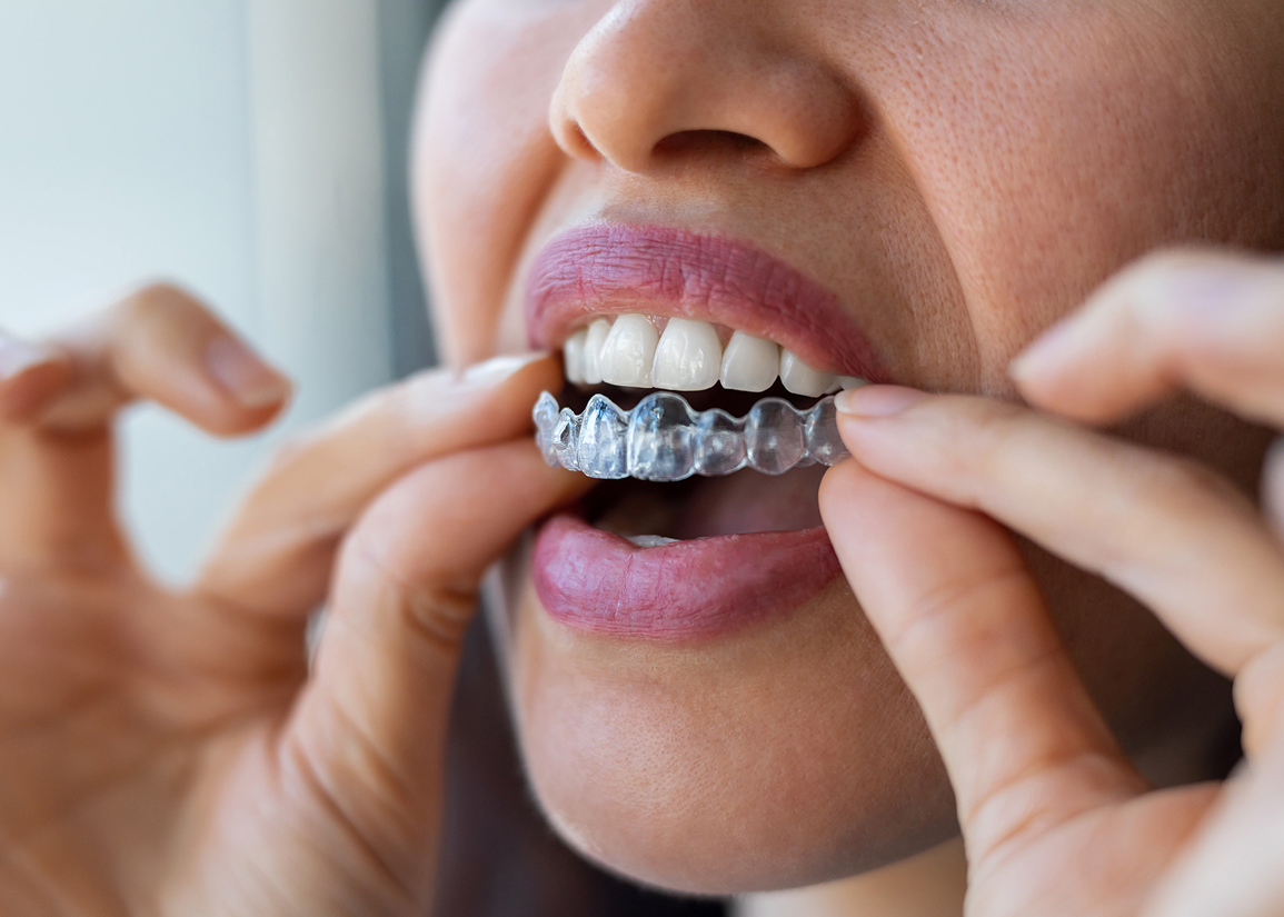 Am I a Candidate for Invisalign?