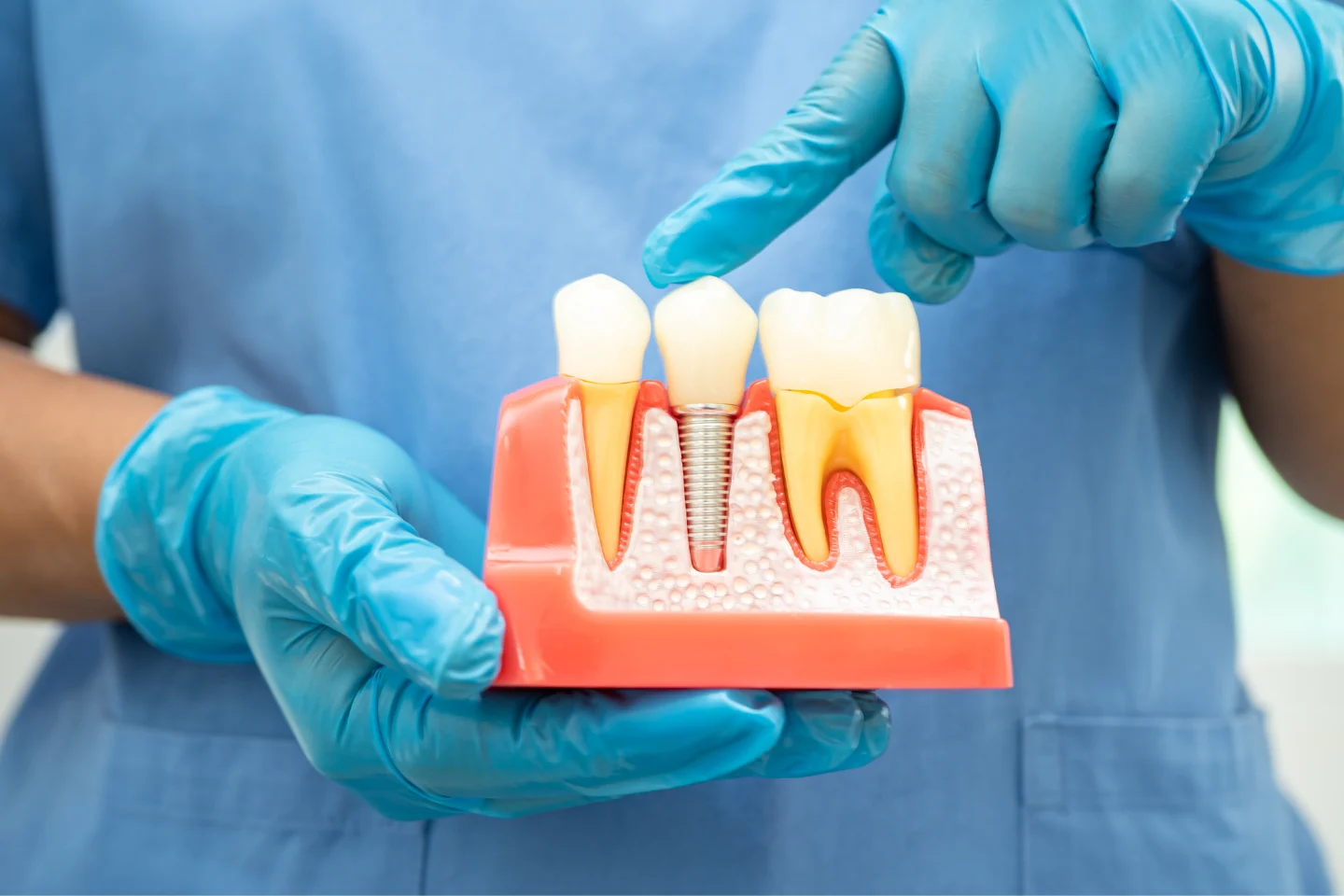 How Dental Implants Prevent Bone Loss (And Dentures Don’t)
