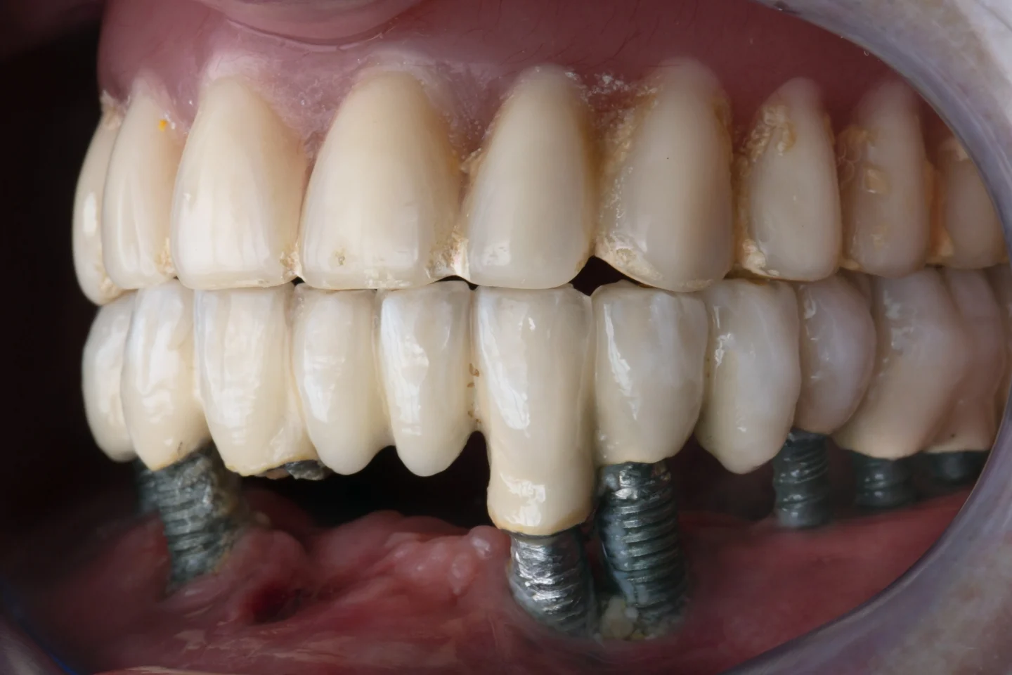 Implant vs. Bridge: Which One Is the Best Long-Term Solution?
