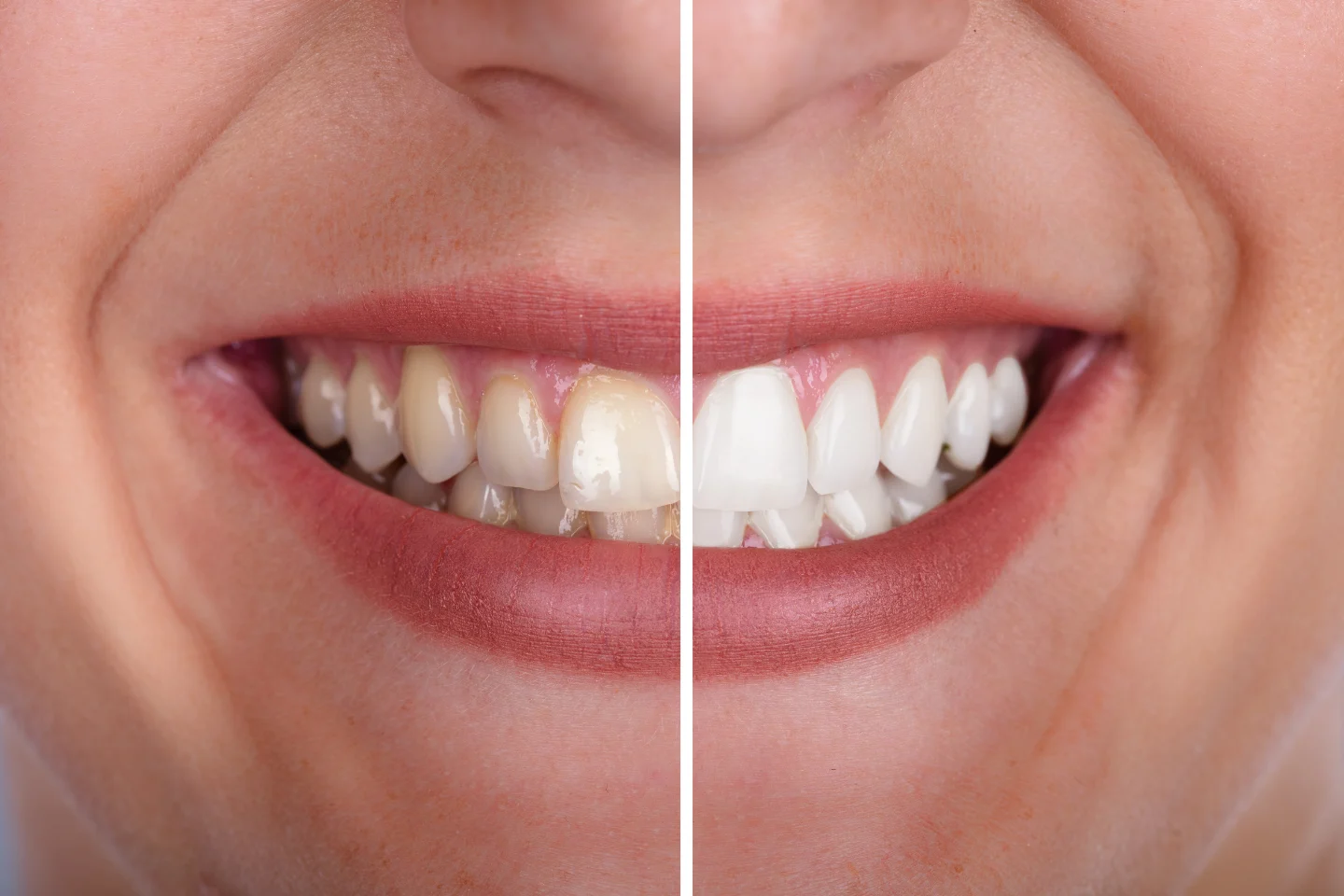 Seven Things That Will RUIN Your Teeth After Whitening