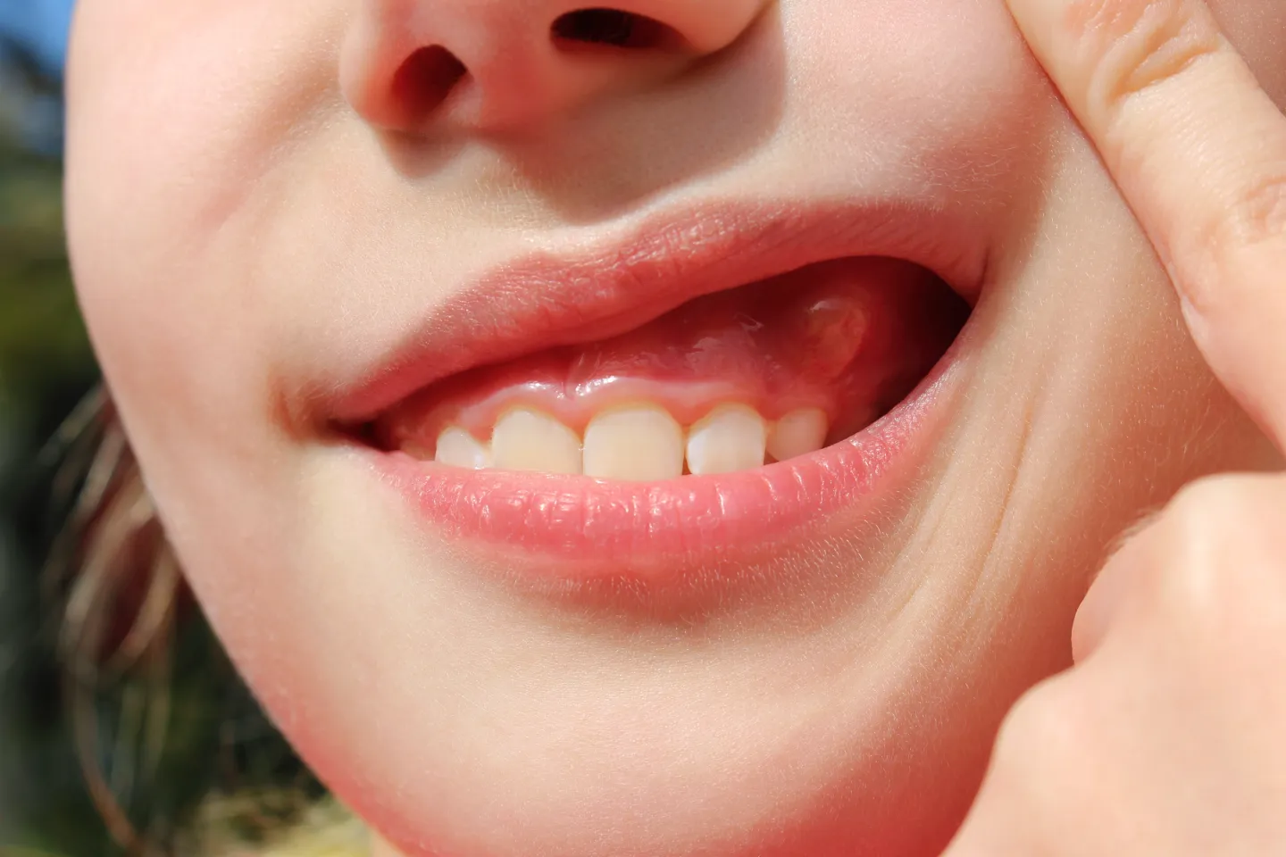 Gum Disease: Causes, Symptoms, and How to Avoid It