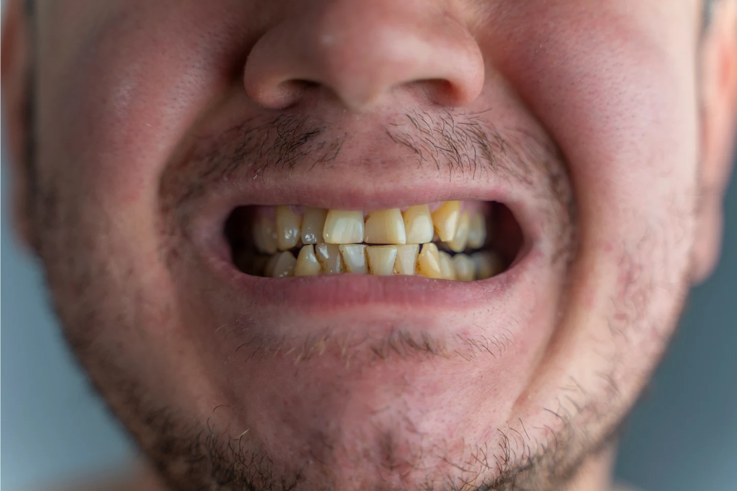 What Causes Yellow Teeth (And How to Fix Them)
