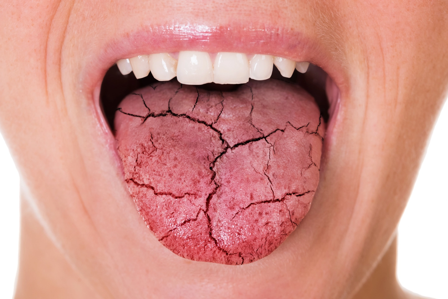 Understanding Dry Mouth: Causes, Effects, and Treatment Options