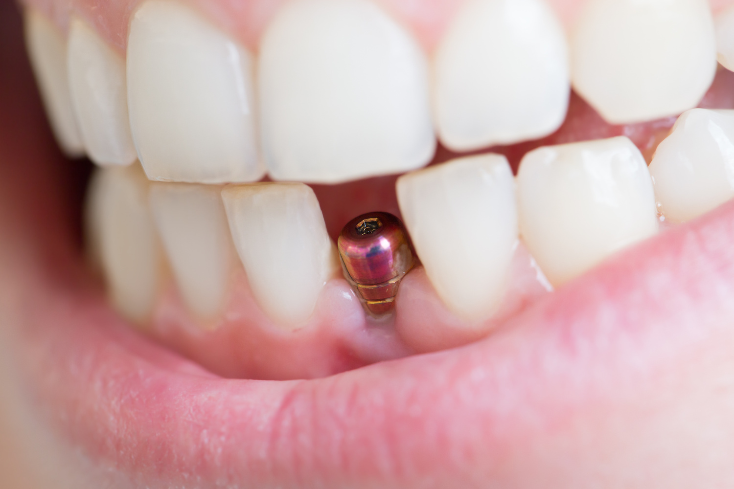 Healing After Dental Implants: What to Expect